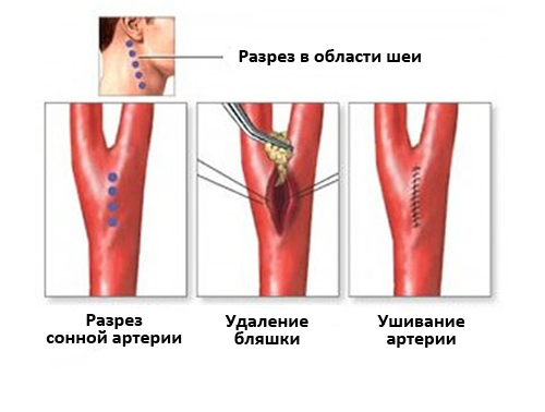 Где Находится Сонная Артерия У Человека Фото