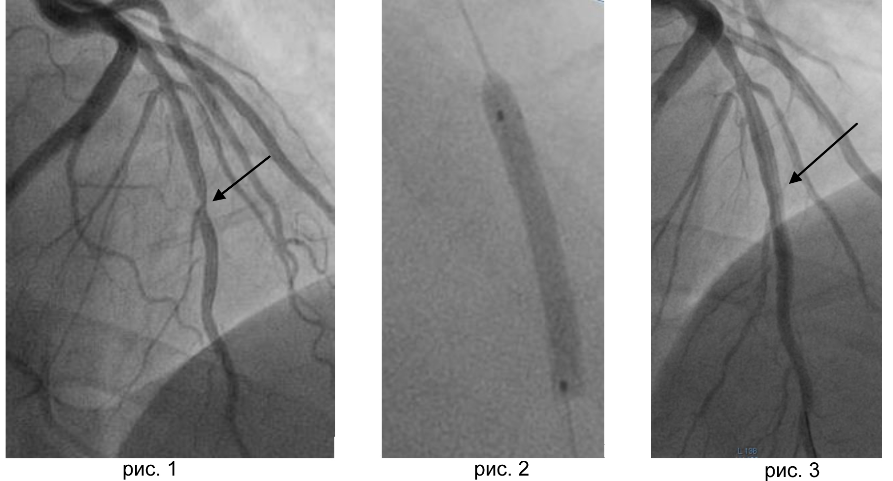 Стентирование сосудов последствия. Коронарография стентирование. Коронарография сосудов стентирование. Коронароангиография стентирование. Коронарные артерии коронароангиография.